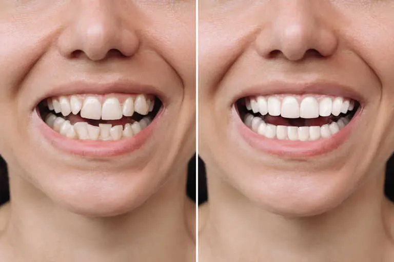 Teeth Before After straight