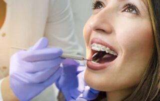 Myths and Misconceptions About Braces