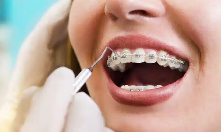 picture of Braces