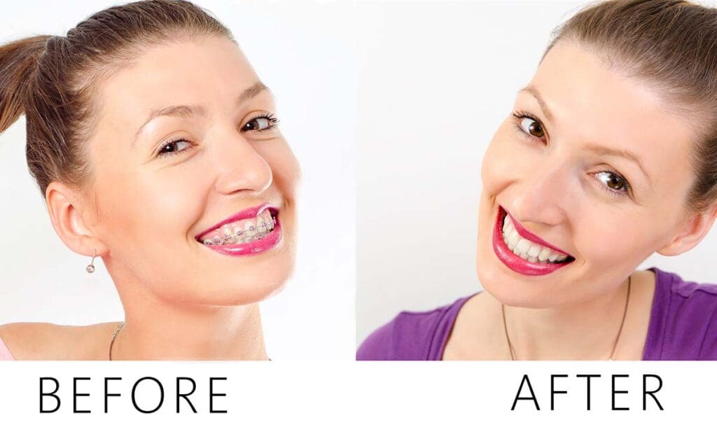 Improve Smile with Orthodontics, Orthodontic Benefits you didn