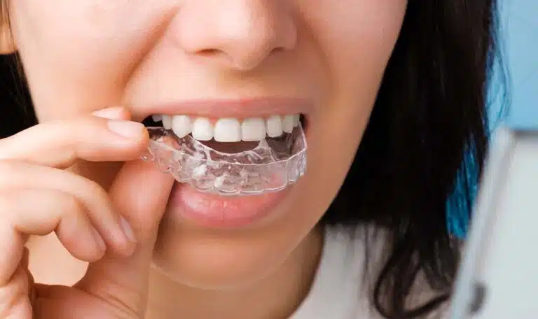 teeth alignment options