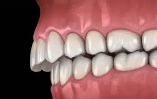 An illustration of misaligned teeth and an overbite, displaying both upper and lower jaws on a black background—perfect for explaining Overbite Treatment with Braces at Elara Orthodontics in Richmond or Houston, TX.