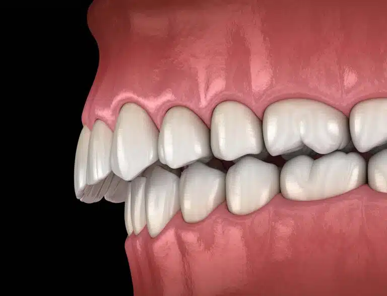 An illustration of misaligned teeth and an overbite, displaying both upper and lower jaws on a black background—perfect for explaining Overbite Treatment with Braces at Elara Orthodontics in Richmond or Houston, TX.