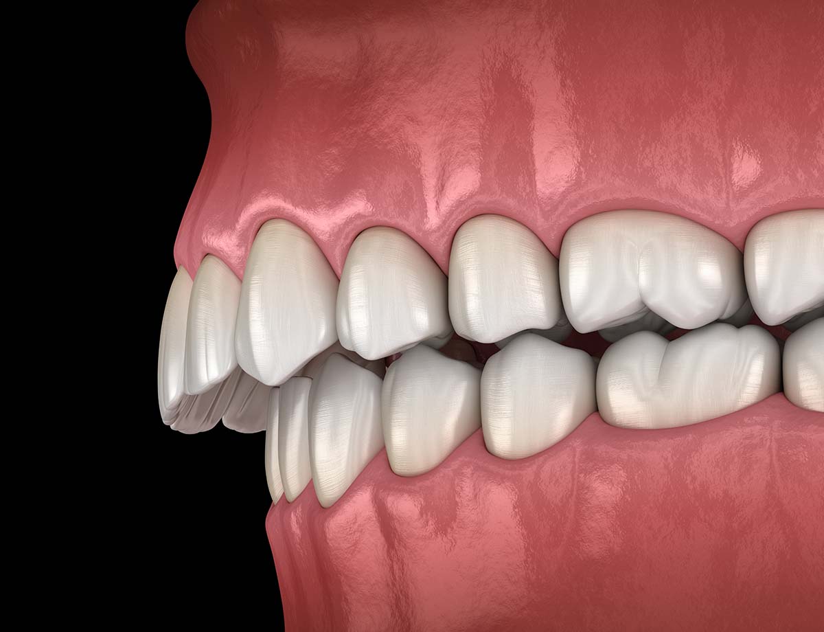 overbite correction braces