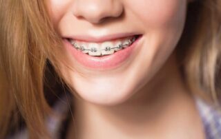 Braces Removal Near Me