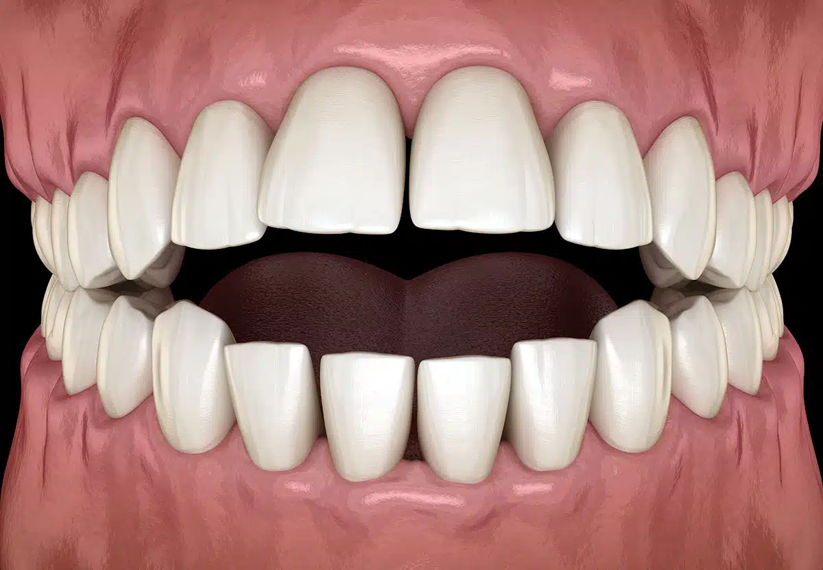 Open Bite Treatment Options