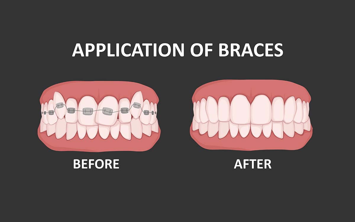 overbite correction, What Types of Braces Work Best to fix Overbite?