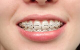 Power Chains for Braces