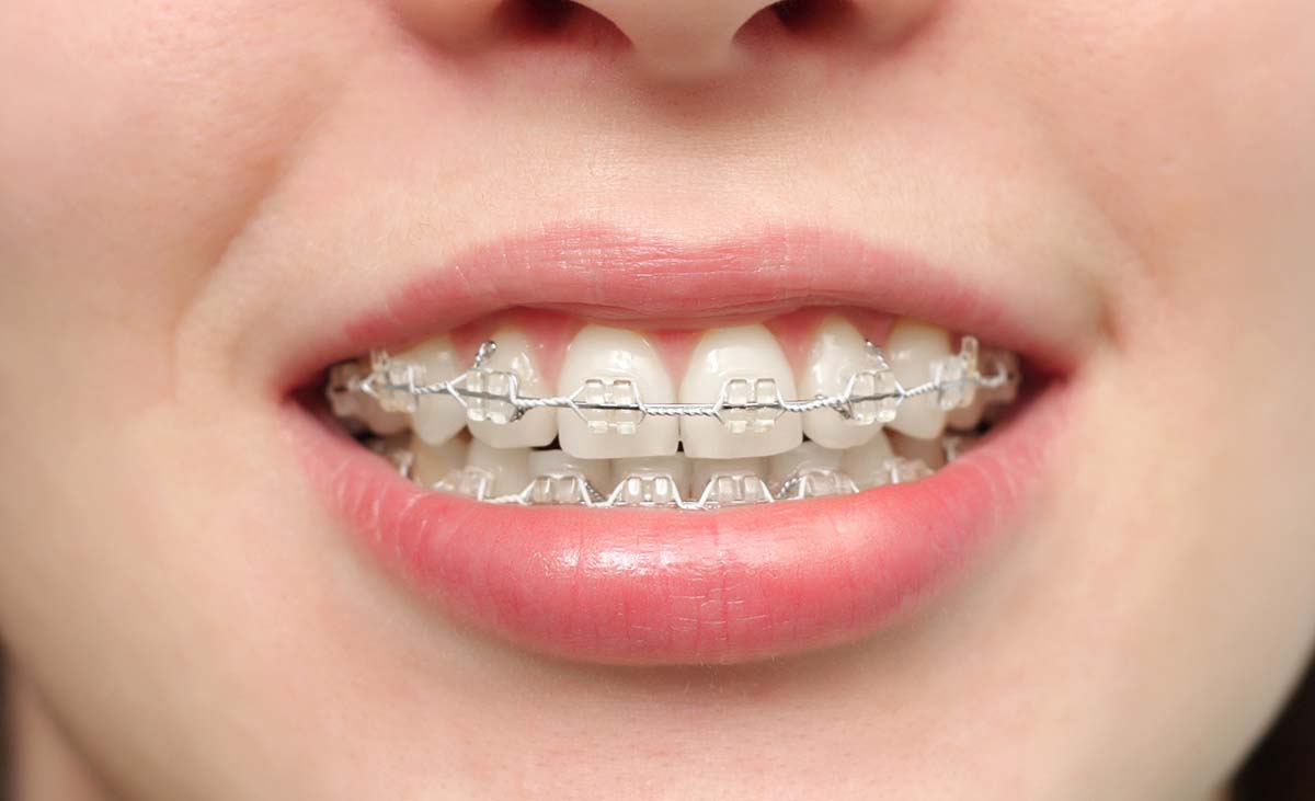 Braces Light Blue Color Powerchain 