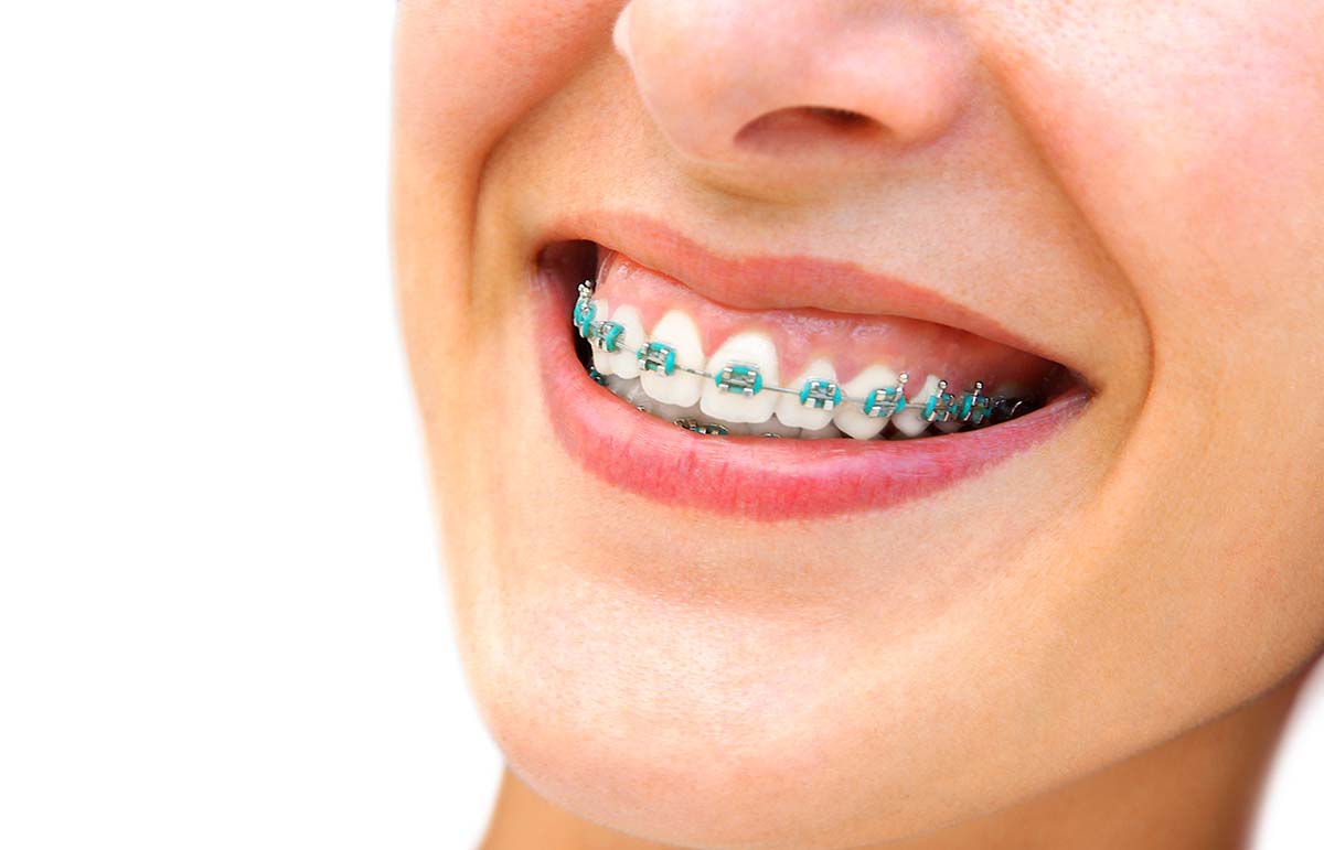 What do Braces Bands Do and What secrets do they reveal?