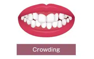 Fix Crowded Teeth with braces
