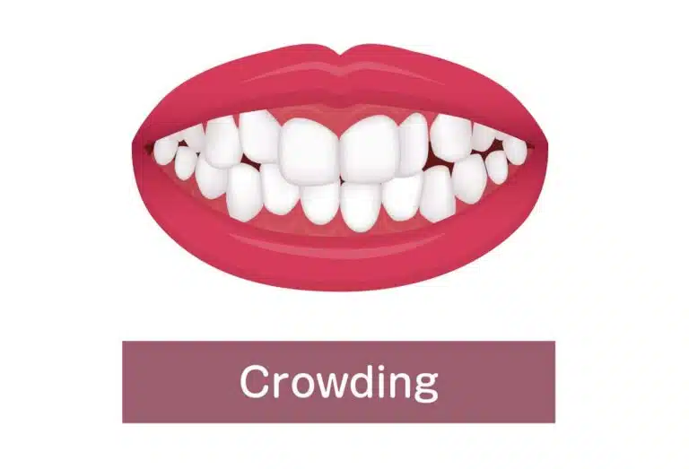 Fix Crowded Teeth with braces
