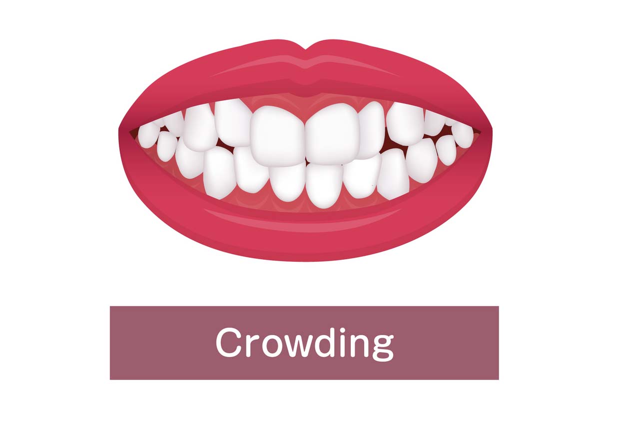 teeth overcrowding treatment - How do braces fix crowding