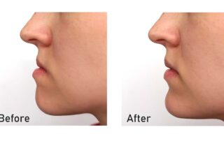 Corrective Jaw Surgery (Jaw Orthognathic Surgery)