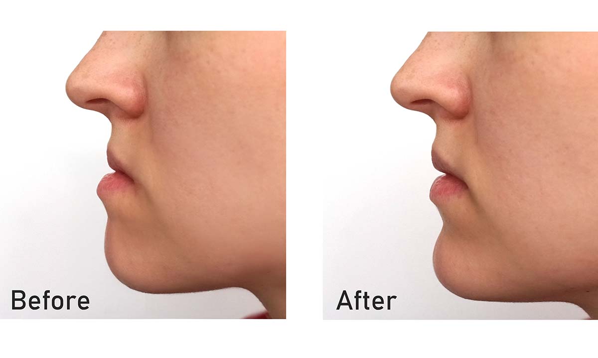 Jaw Orthognathic Surgery