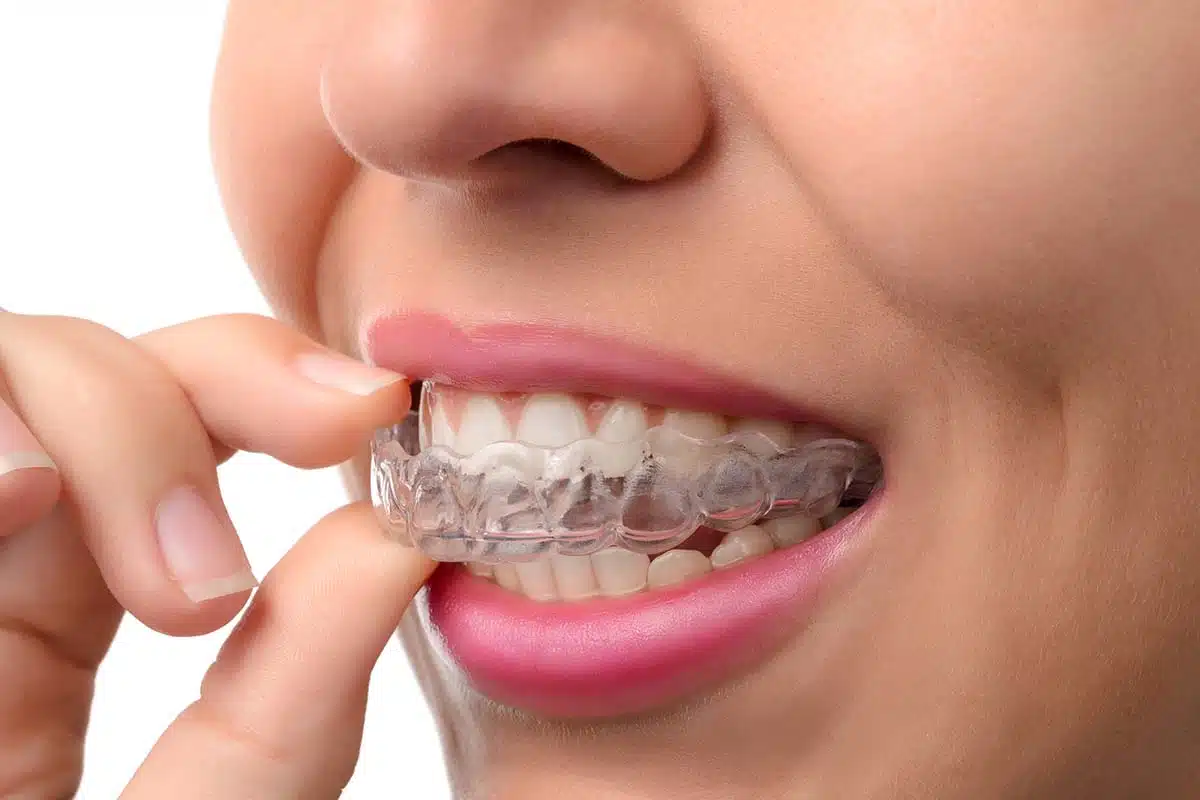 Clear Braces