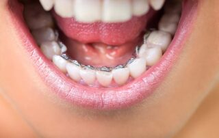 lingual braces in Texas