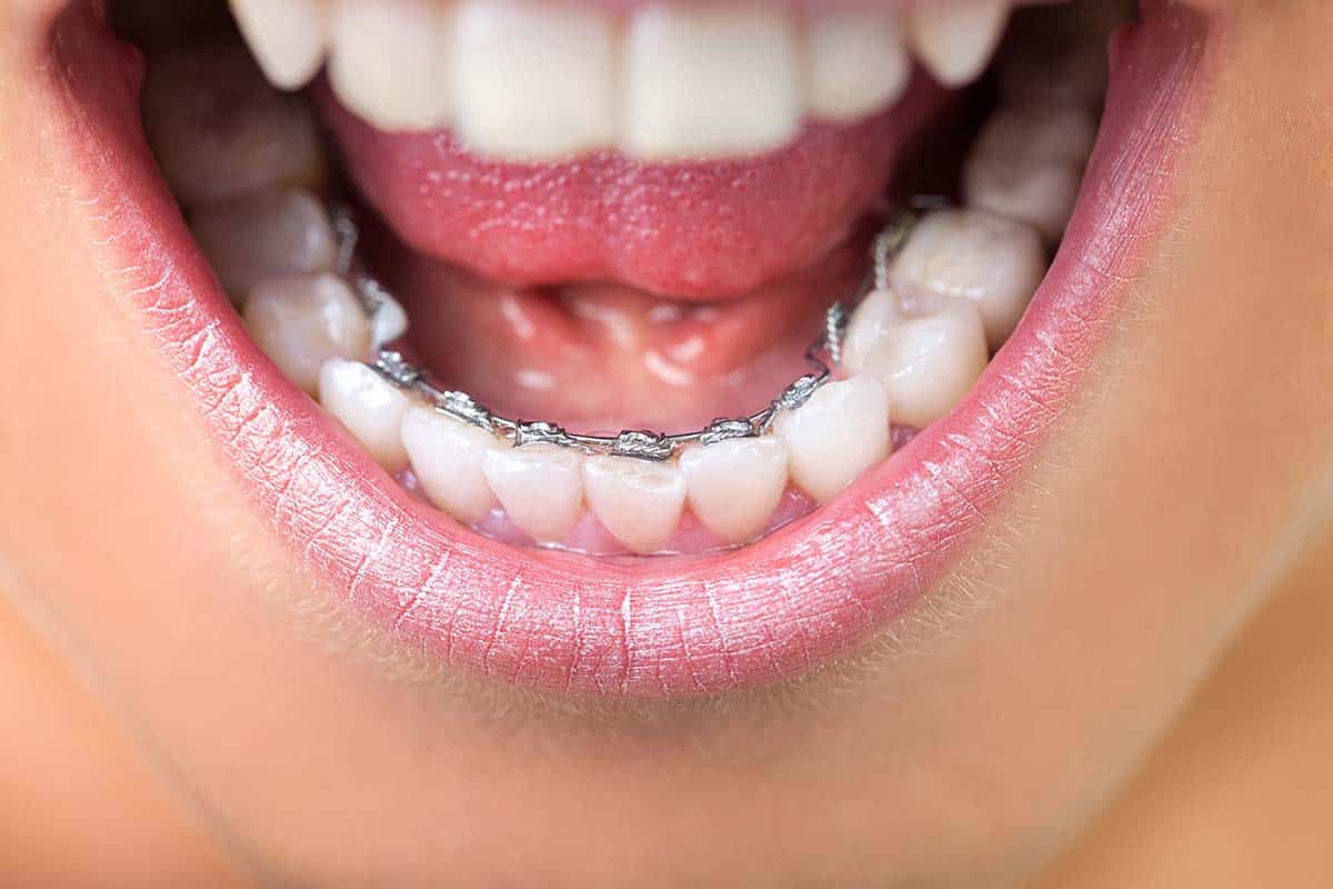 lingual braces in Texas