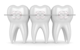 Pros and Cons of Ceramic Braces