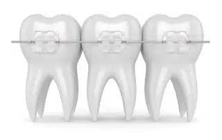 Pros and Cons of Ceramic Braces