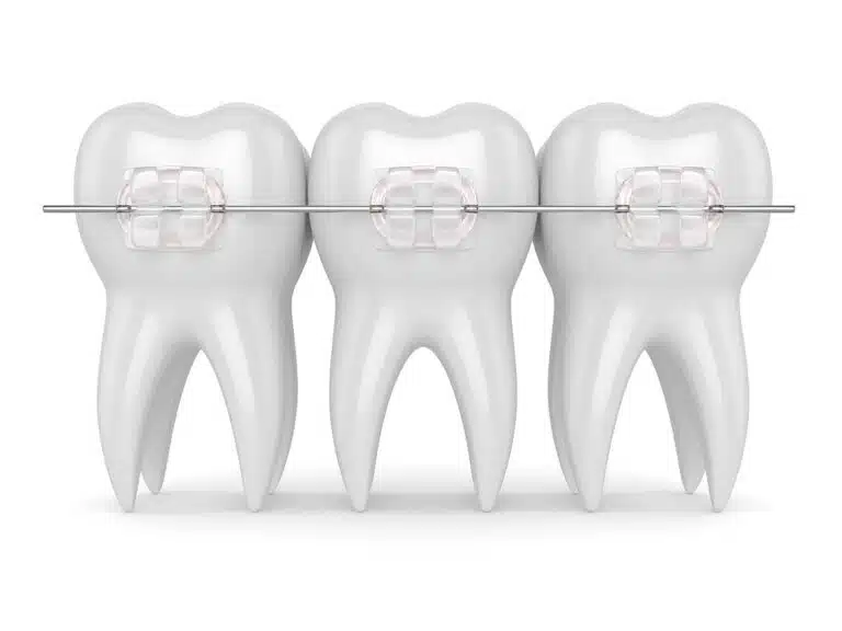 Pros and Cons of Ceramic Braces