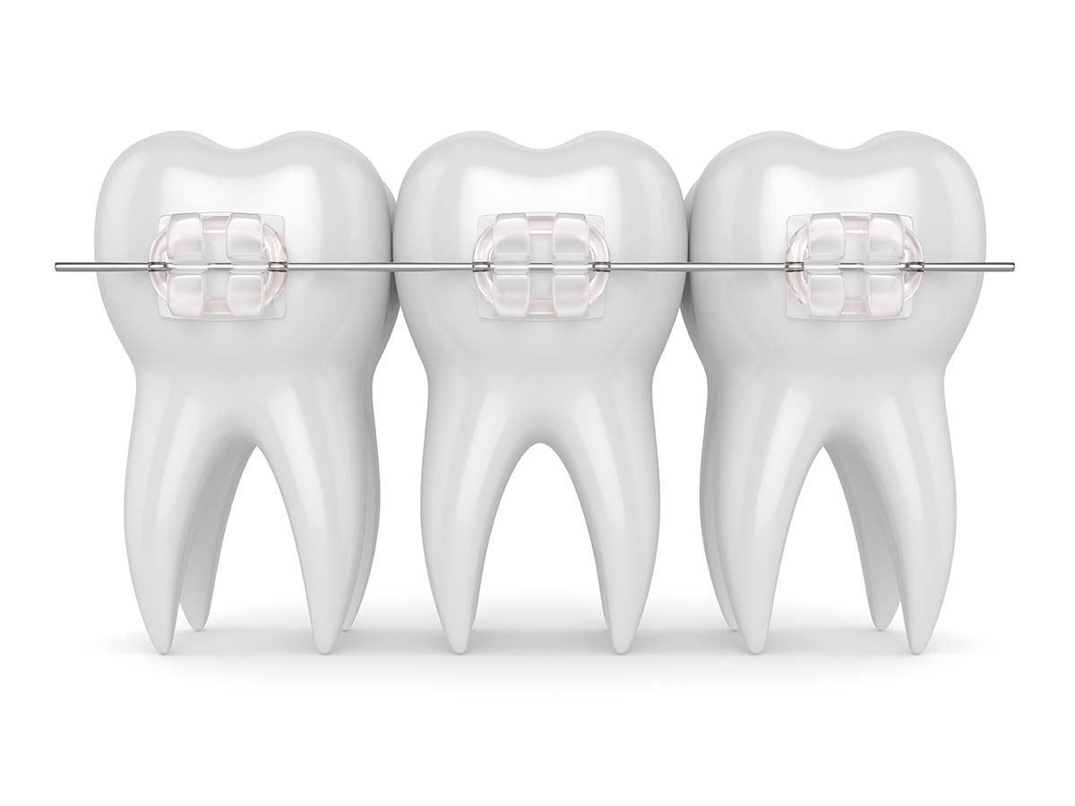 Pros And Cons Of Ceramic Braces