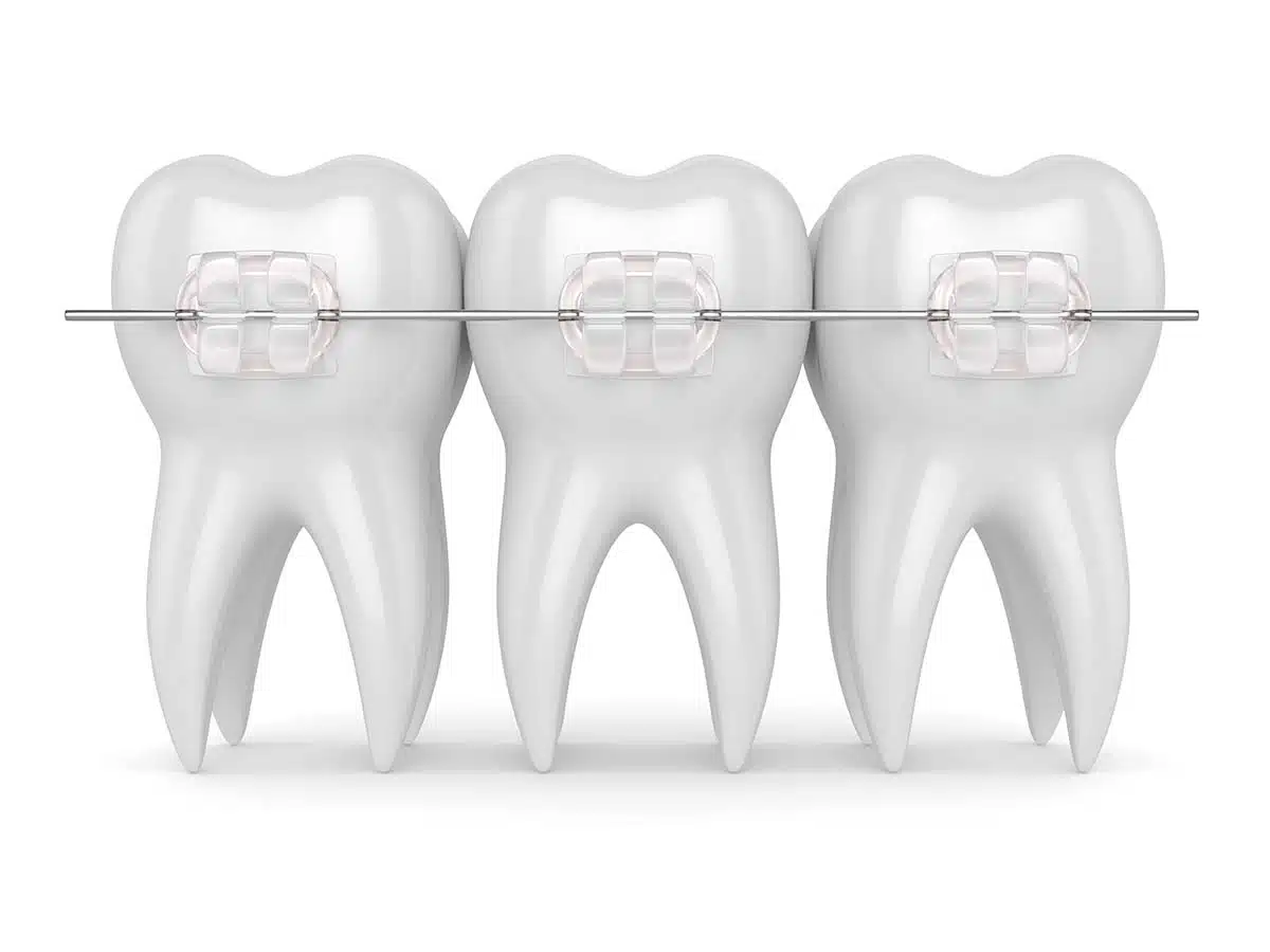 Pros and Cons of Ceramic Braces