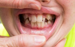 Crooked Teeth treatment