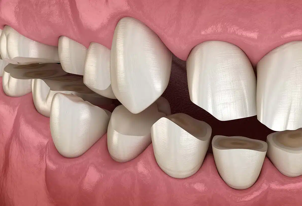 Grinding, Bruxism