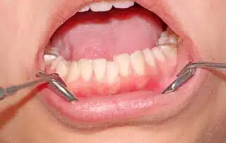 overcrowding teeth treatment