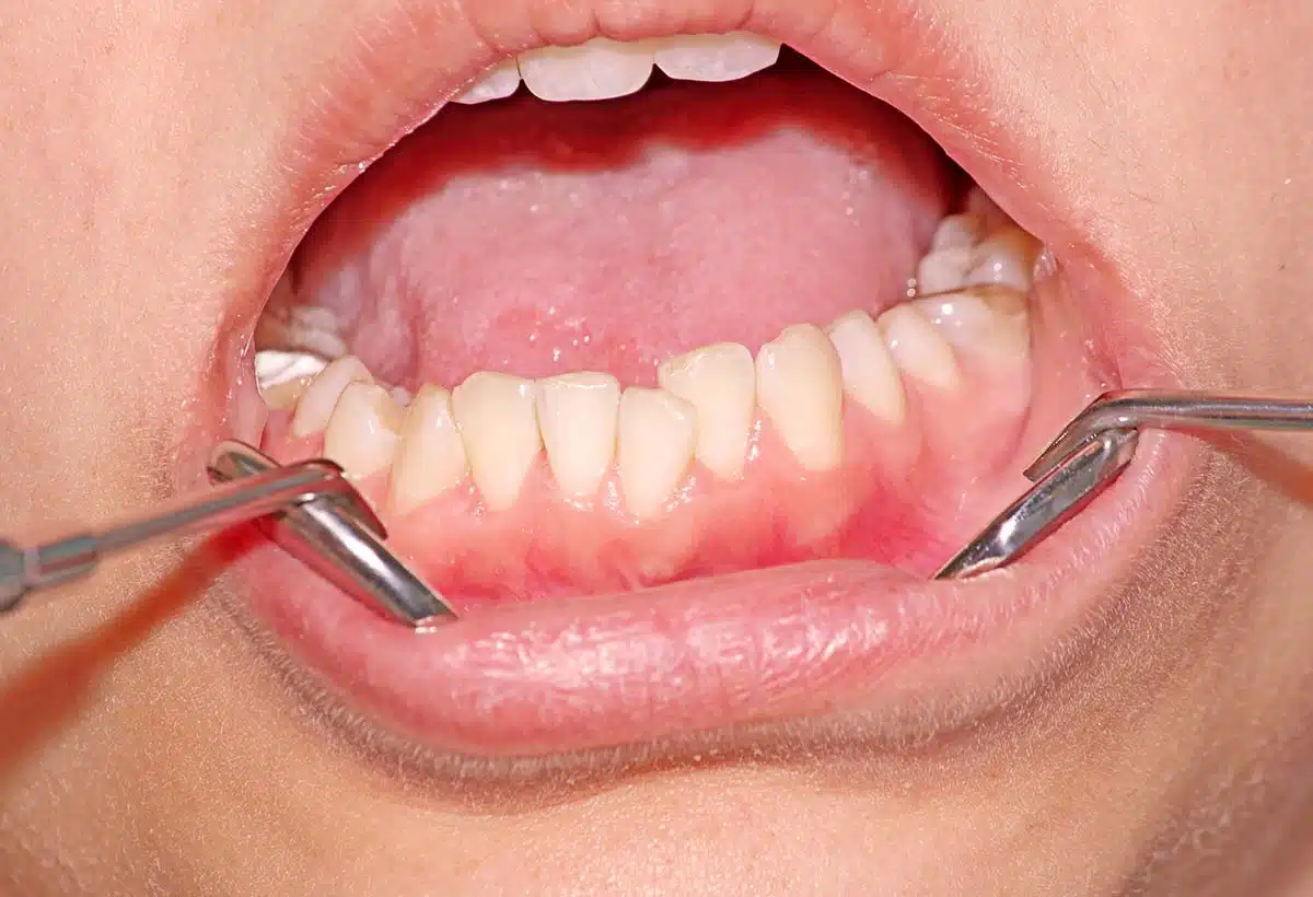 overcrowding teeth treatment