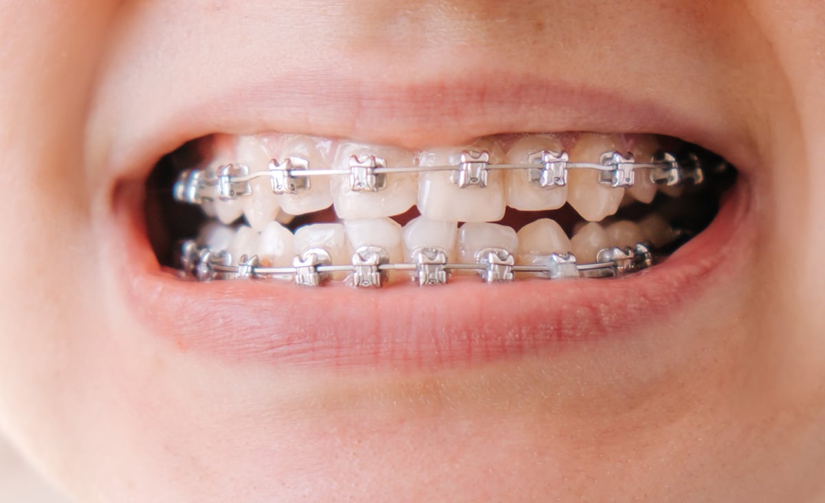 Malocclusion in Children