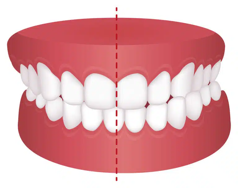 Picture of Cross Bite