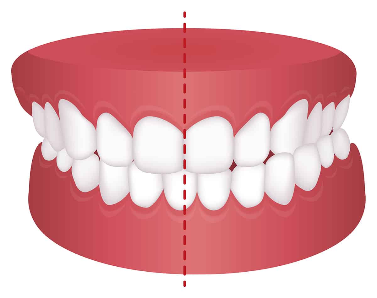 crossbite braces before after