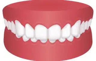 Picture of Deep Bite