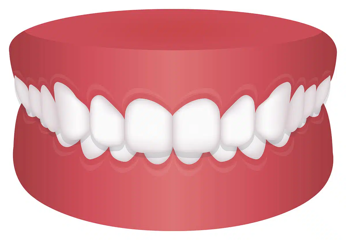 Picture of Deep Bite