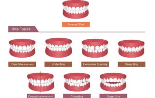 Different Types of Bites Kids Experience