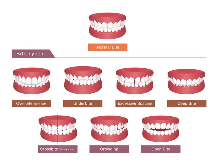 bug-bite-chart-insect-bite-treatment-insect-bites-insect-bite-remedy