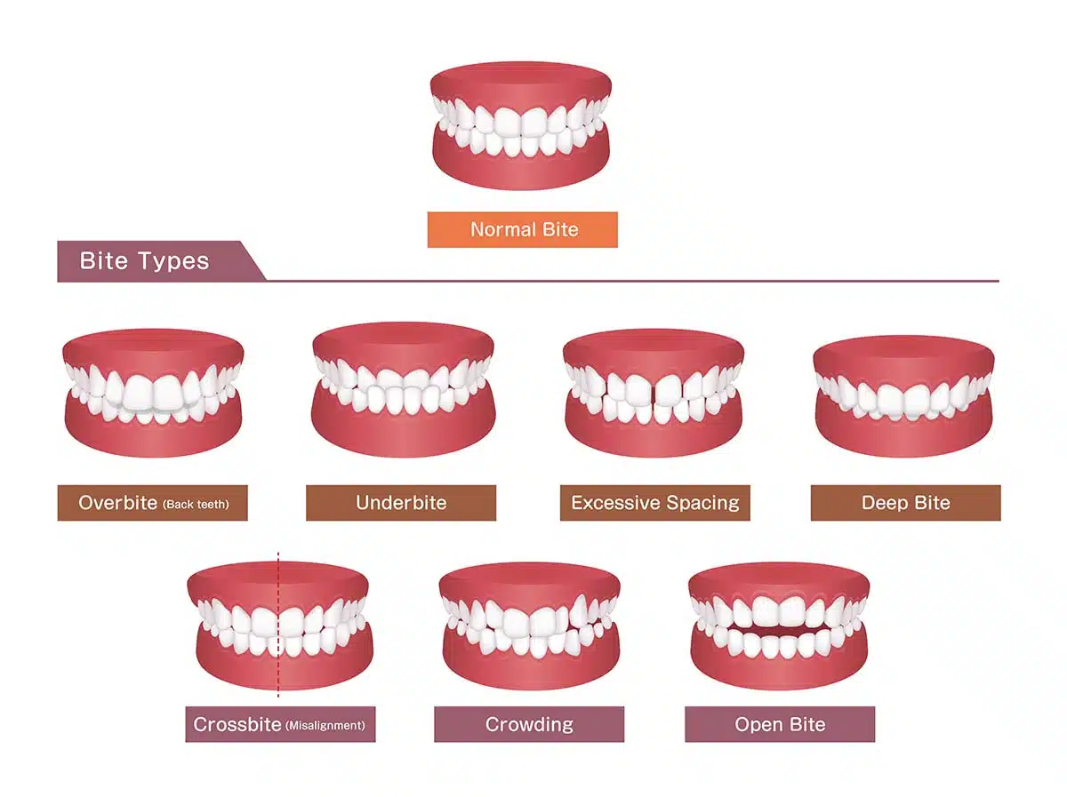 Different Types of Bites Kids Experience
