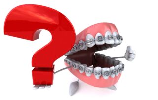 Braces FAQ