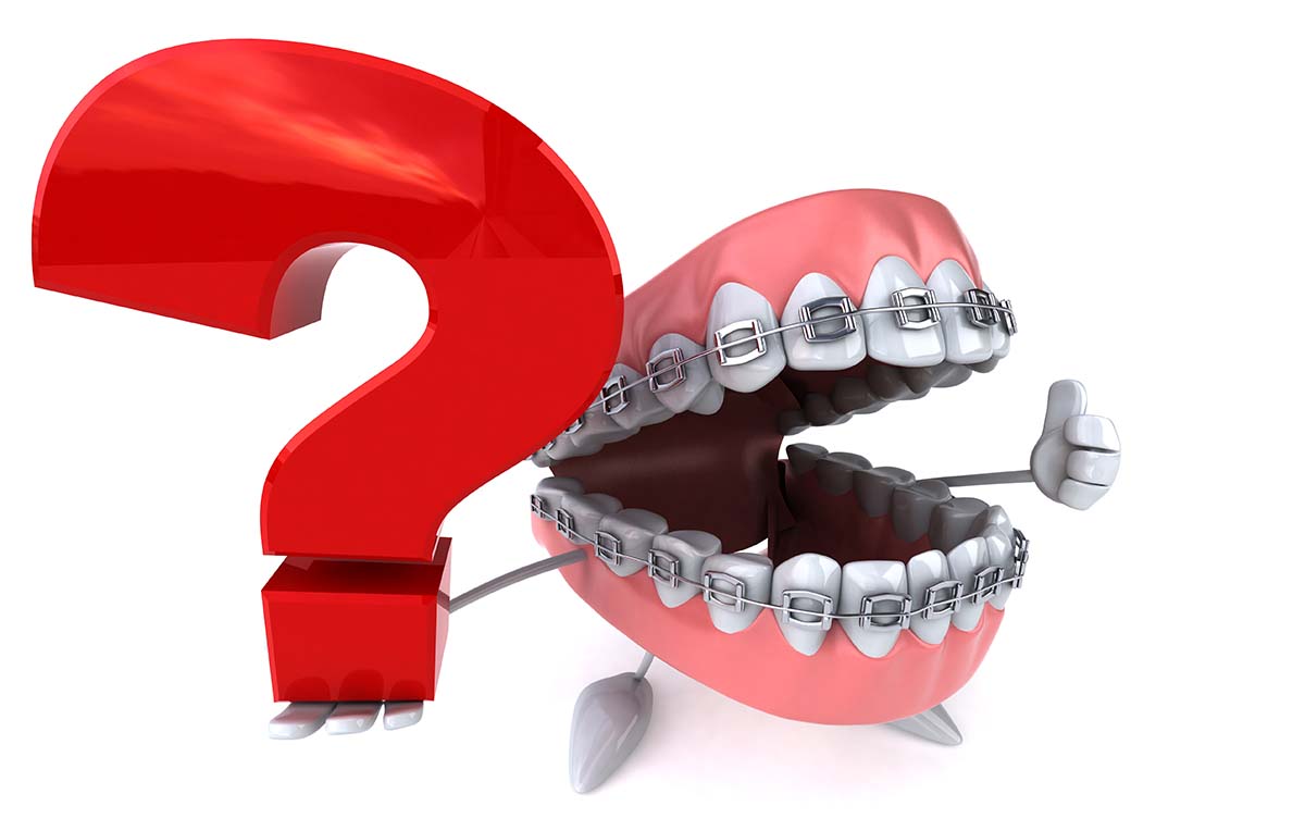 braces faq