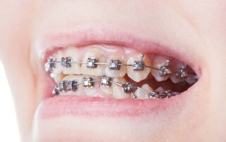 picture of dental braces