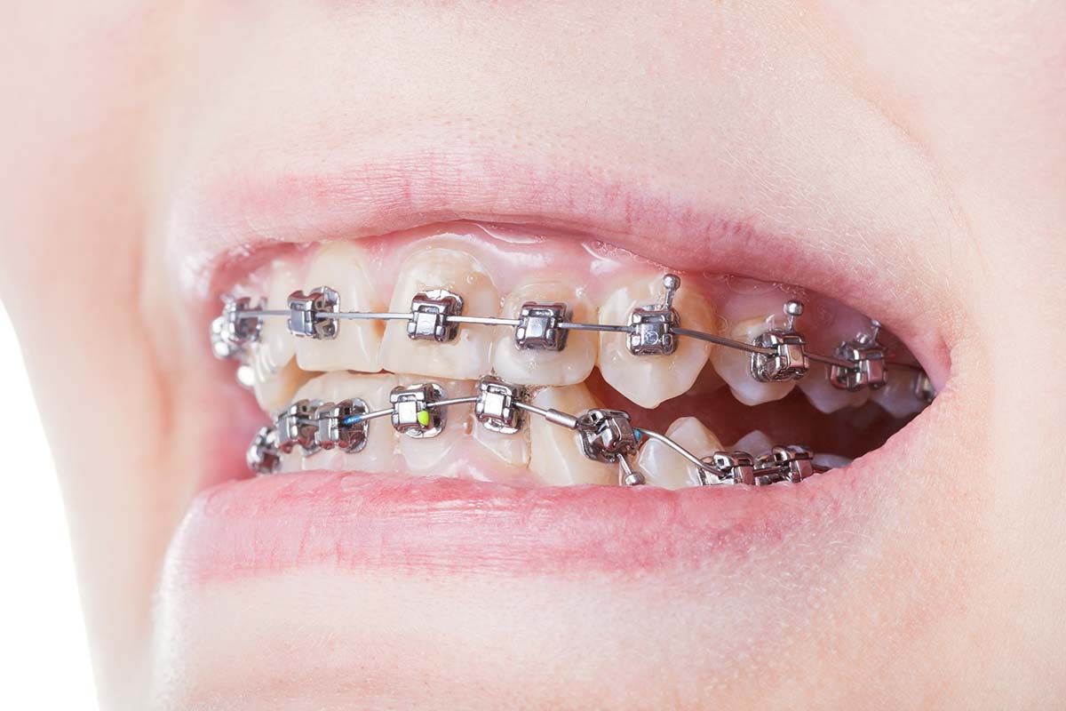 picture of dental braces