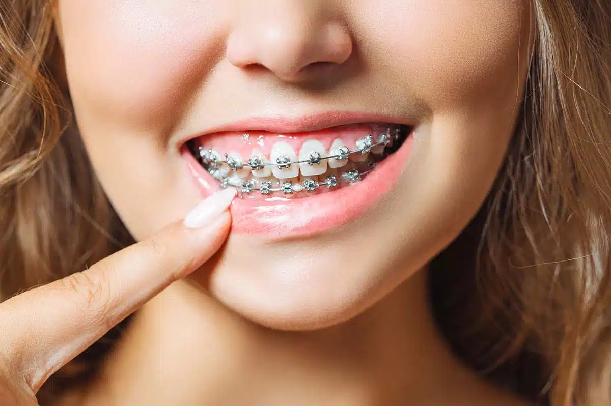 Happy girl with Braces