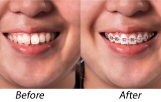 braces before and after