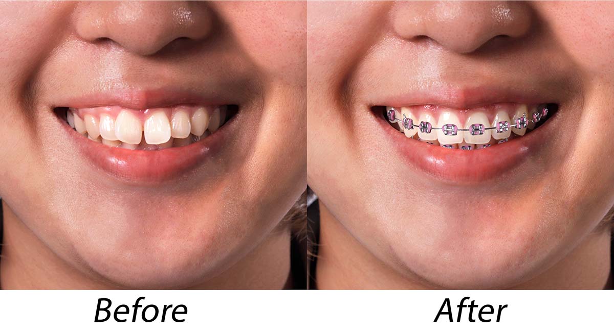 braces before after