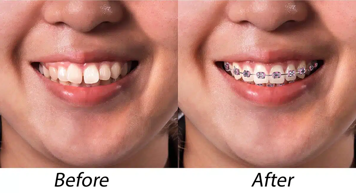 braces before and after