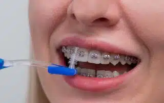 Braces and Cavity