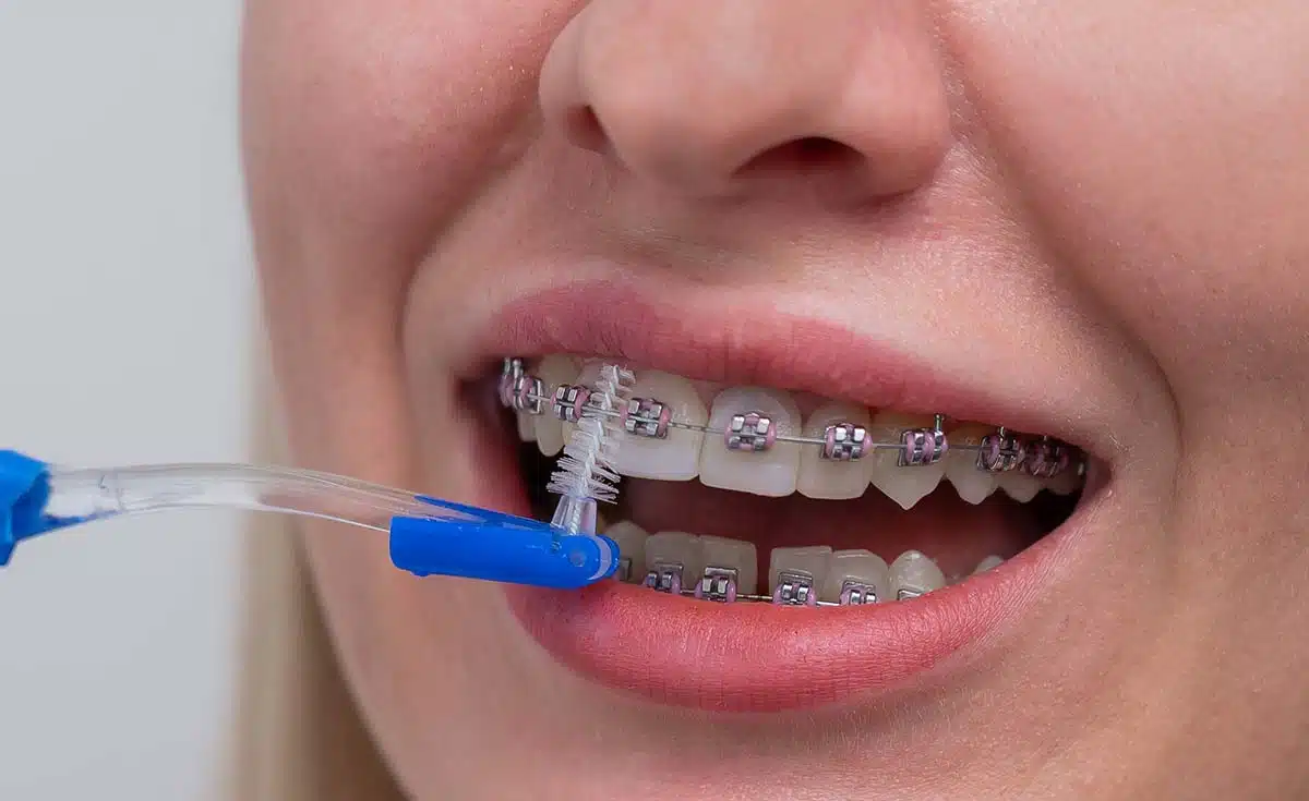 Braces and Cavity