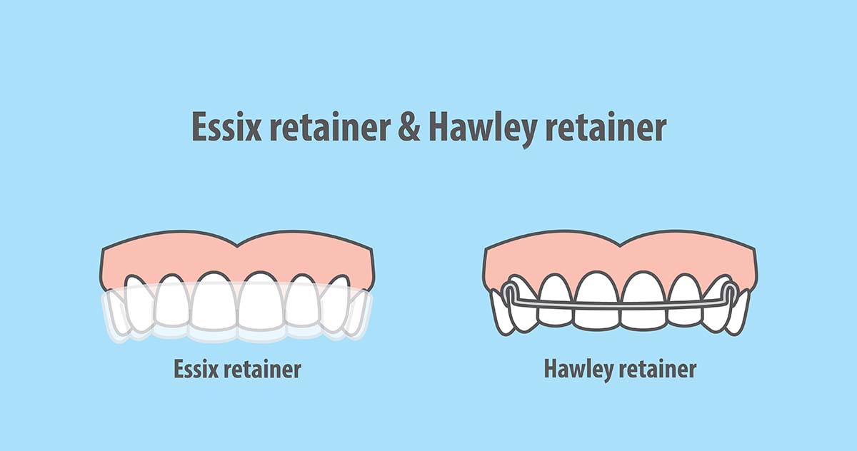 types of retainers